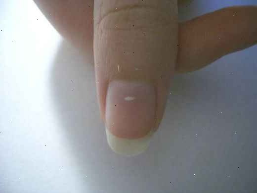 Hvordan bli kvitt de hvite flekker på neglene. Løsningen er å bare tillate dem å vokse ut.