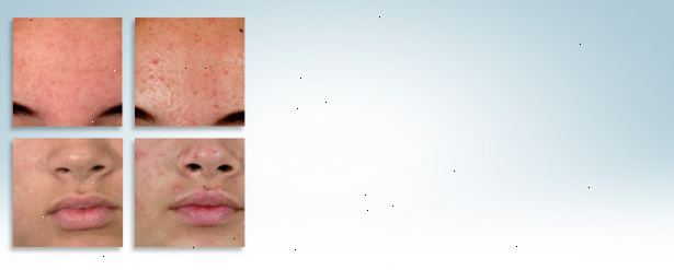 Hvordan å se de positive effektene av acne. Tenk på det gode som har kommet ut av akne.